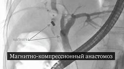 Магнитно-компрессионный анастомоз для лечения стриктур желчевыводящих путей после холецистэктомии. +Видео.